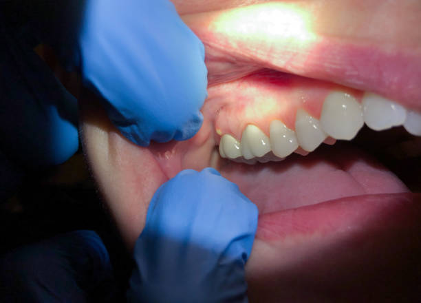 Best Emergency Dental Care for Abscessed Tooth in Port Salerno, FL